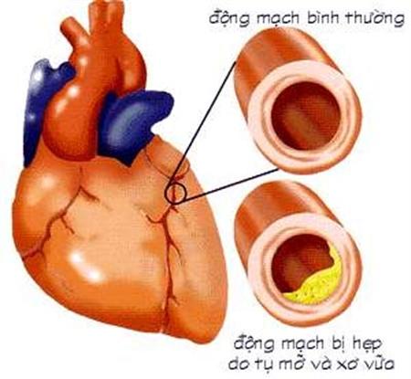 Bệnh tim mạch